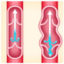Varices